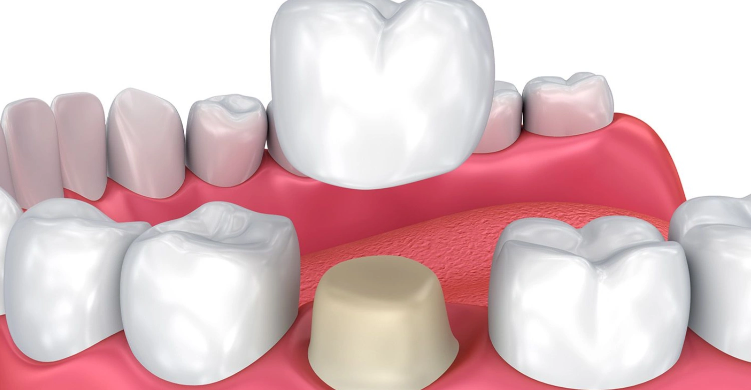 dental crown tooth pain inblog